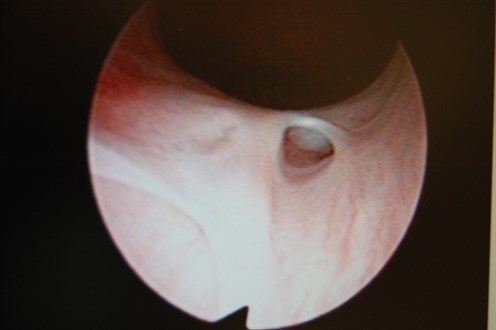 Ectopic ureter