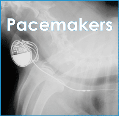 Pacemakers