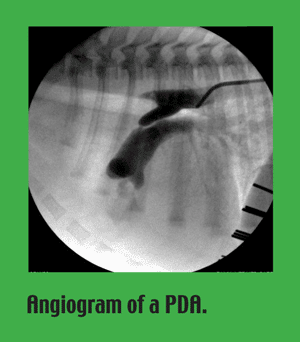 PDA Angiogram