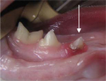 Stage 3 Lesions Teeth