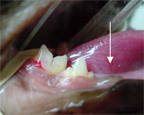 Stage 5 Lesions Teeth