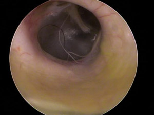 Normal ear canal