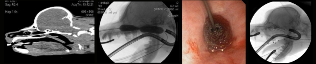 nasopharyngeal stenosis